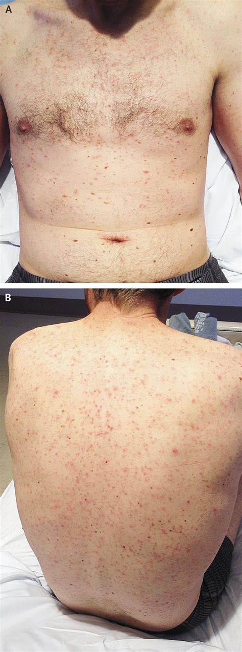 Morphea tends to affect only the outer layers of your skin. . Liver disease rash pictures